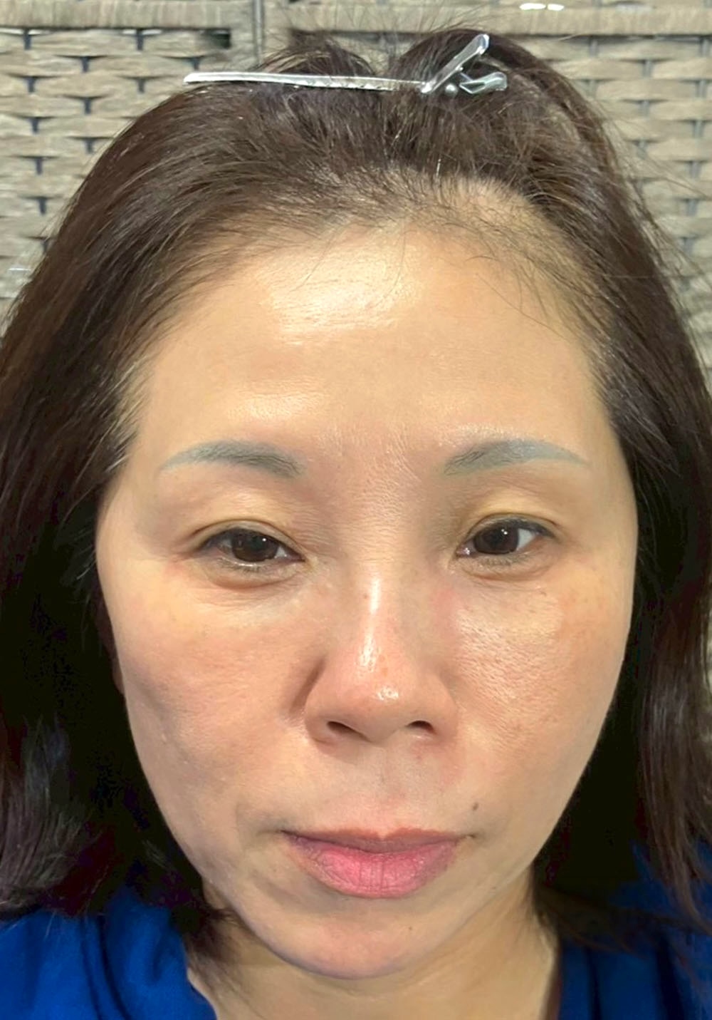 フェイスケア｜アフター