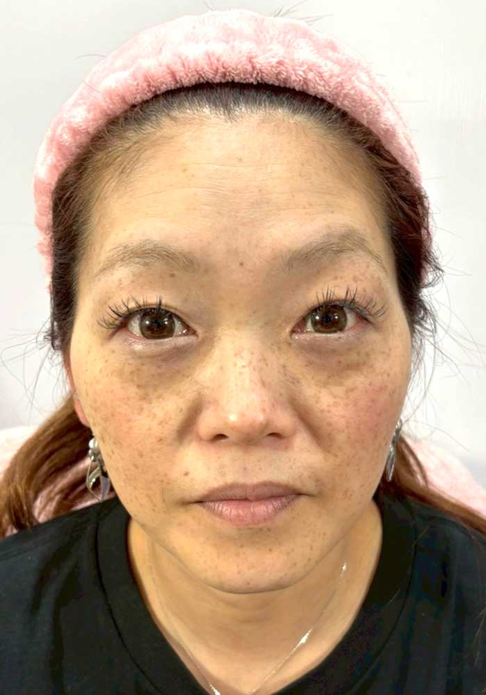 フェイスケア｜ビフォー