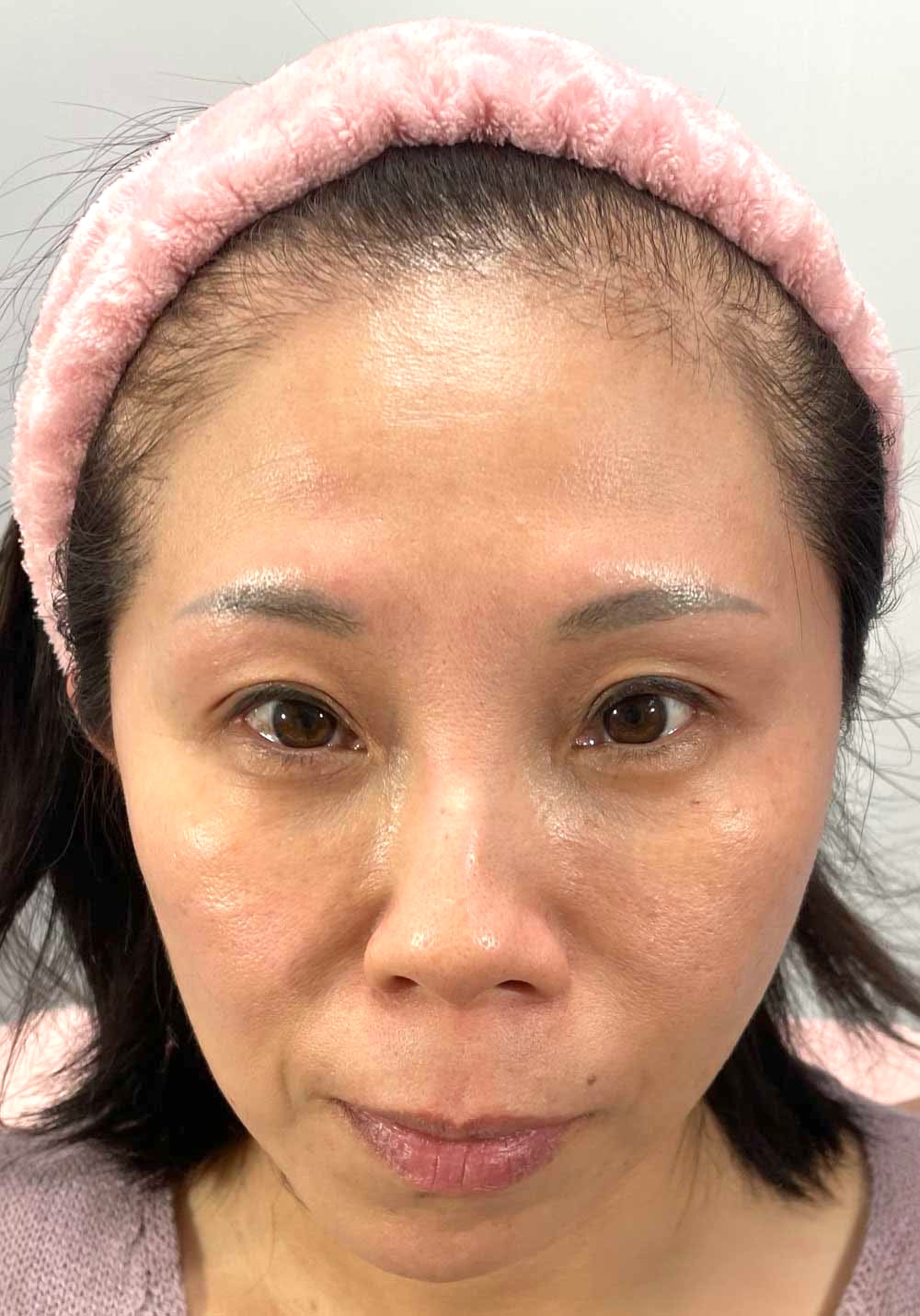 フェイスケア｜ビフォー