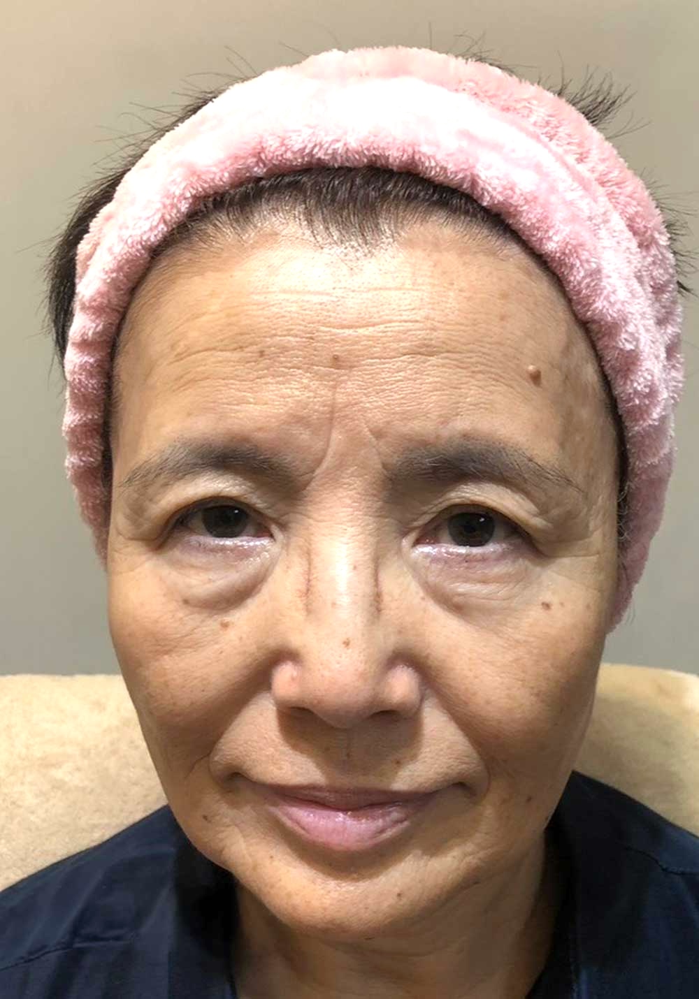 フェイスケア｜ビフォー