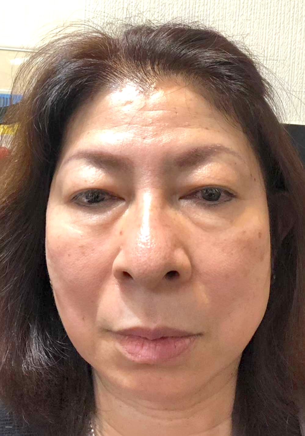 フェイスケア｜ビフォー