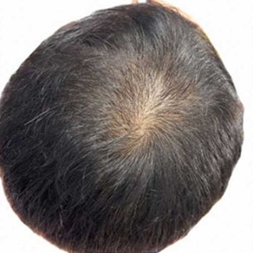 頭皮ケア｜アフター