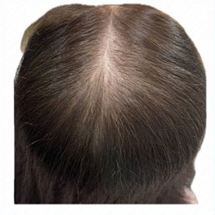 頭皮ケア｜アフター