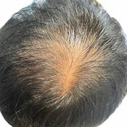 頭皮ケア｜ビフォー