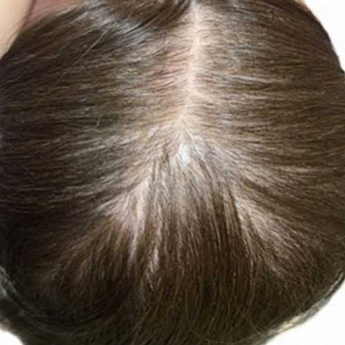 頭皮ケア｜ビフォー