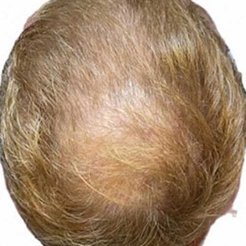 頭皮ケア｜ビフォー